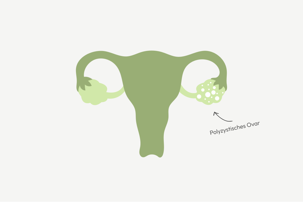 Grafik eines polyzistischen Ovar 
